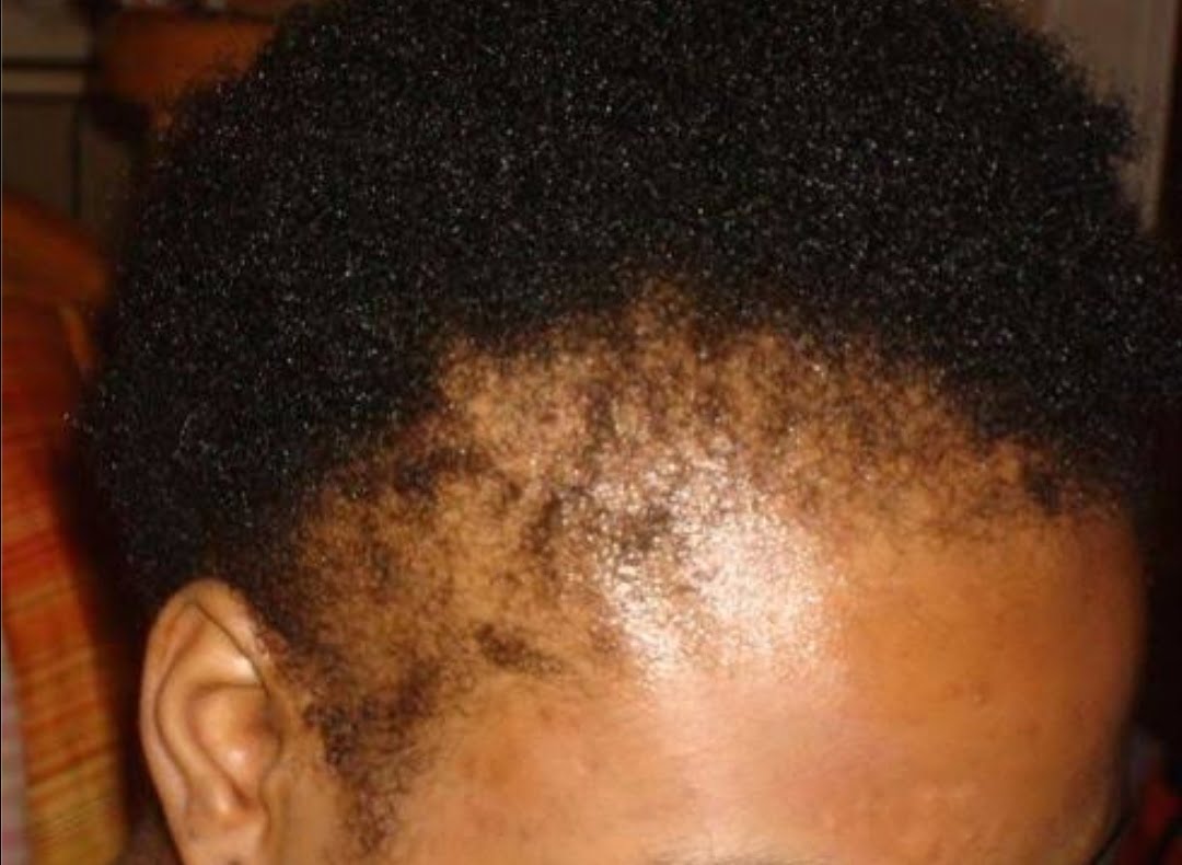 Ways to grow back your hairline and be full