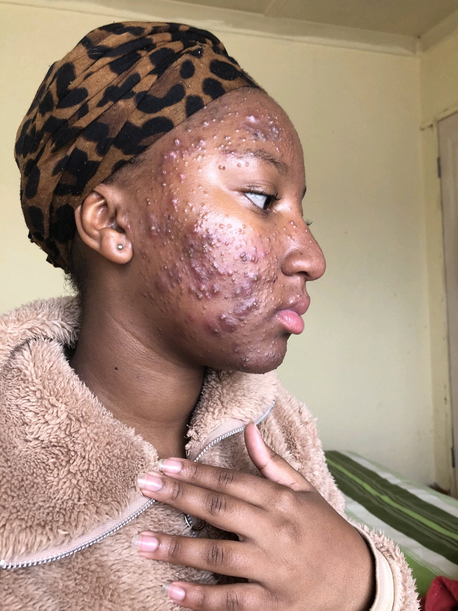 See how it started and how it ended for a girl with severe acne