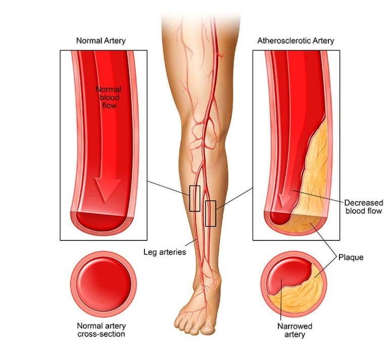 Causes of leg pains at night