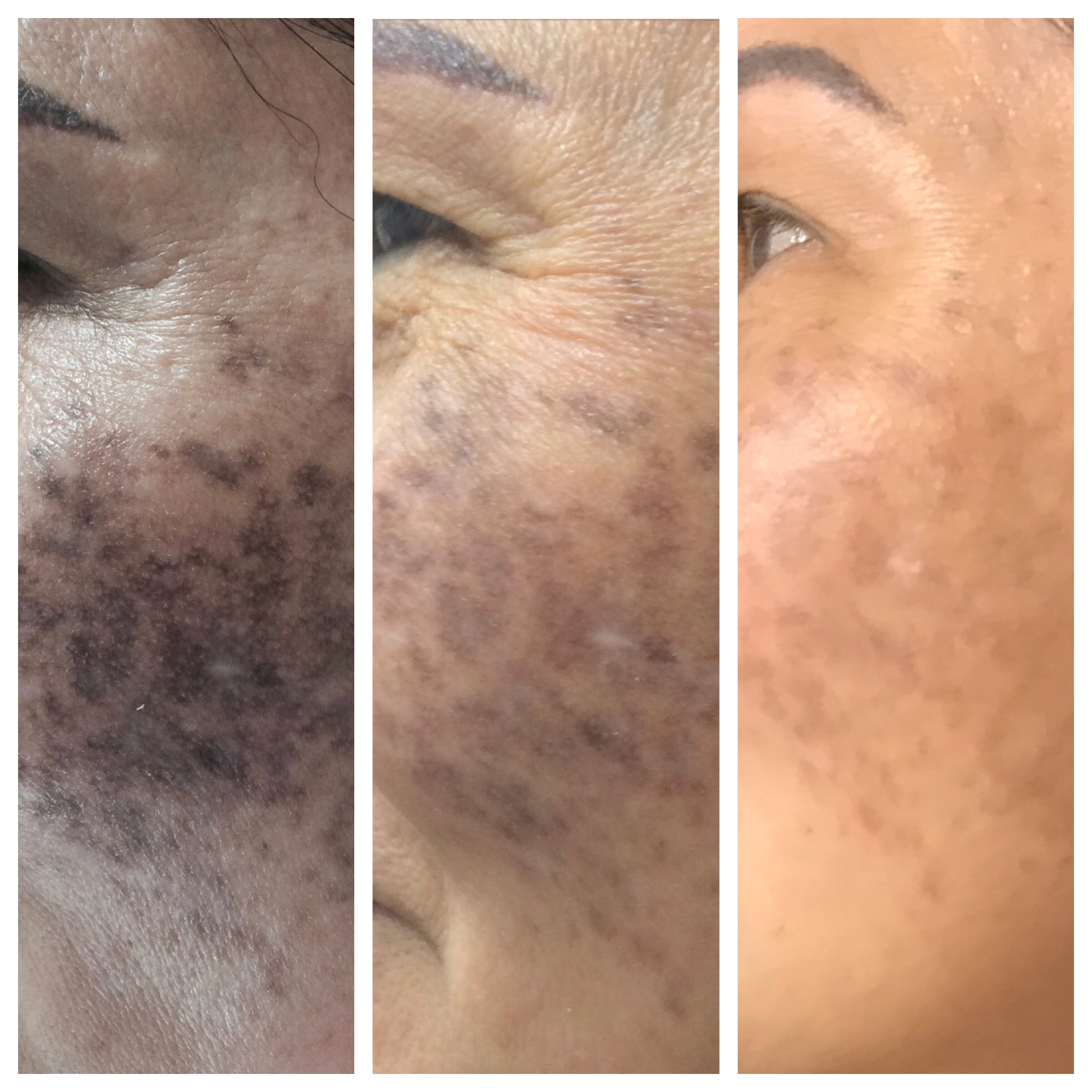 Dark spots laser removal: Do Lasers Hurt? Here’s what to expect!!